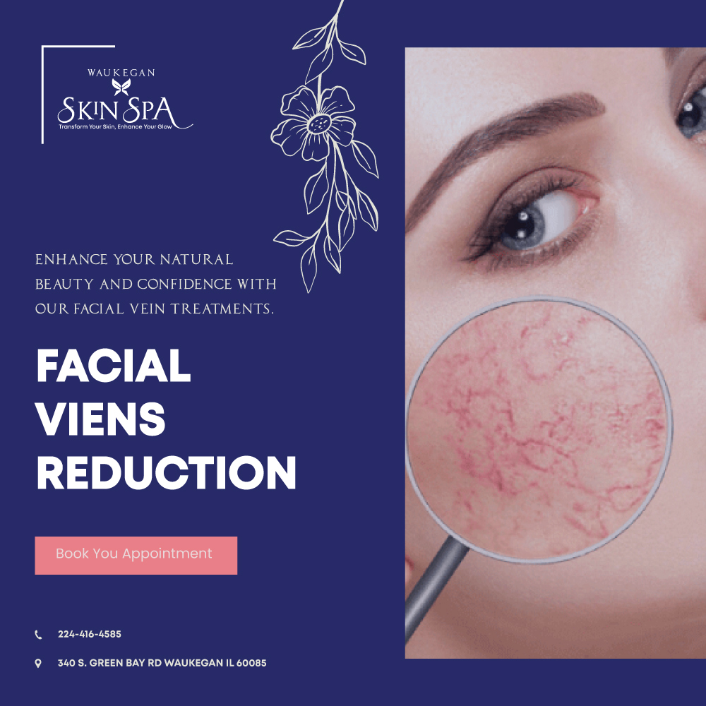 facial-Veins-Reduction